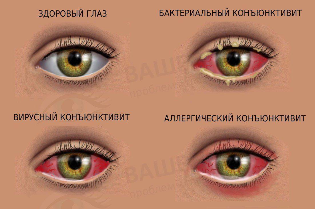 Раздражение глаз Три вида конъюнктивита и норма