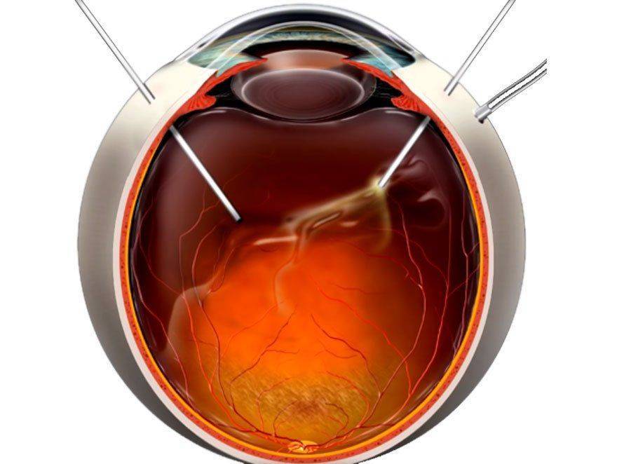 Как проходит витрэктомия Схема витрэктомии