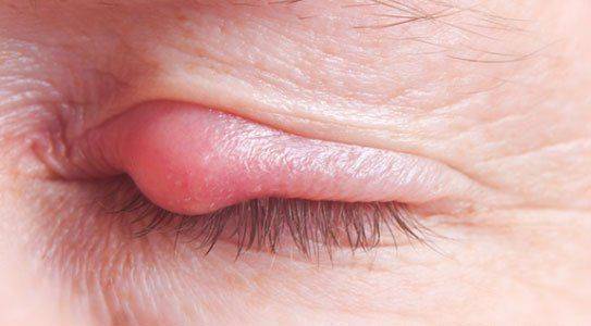 Шишка в виде ячменя Фурункул на глазу