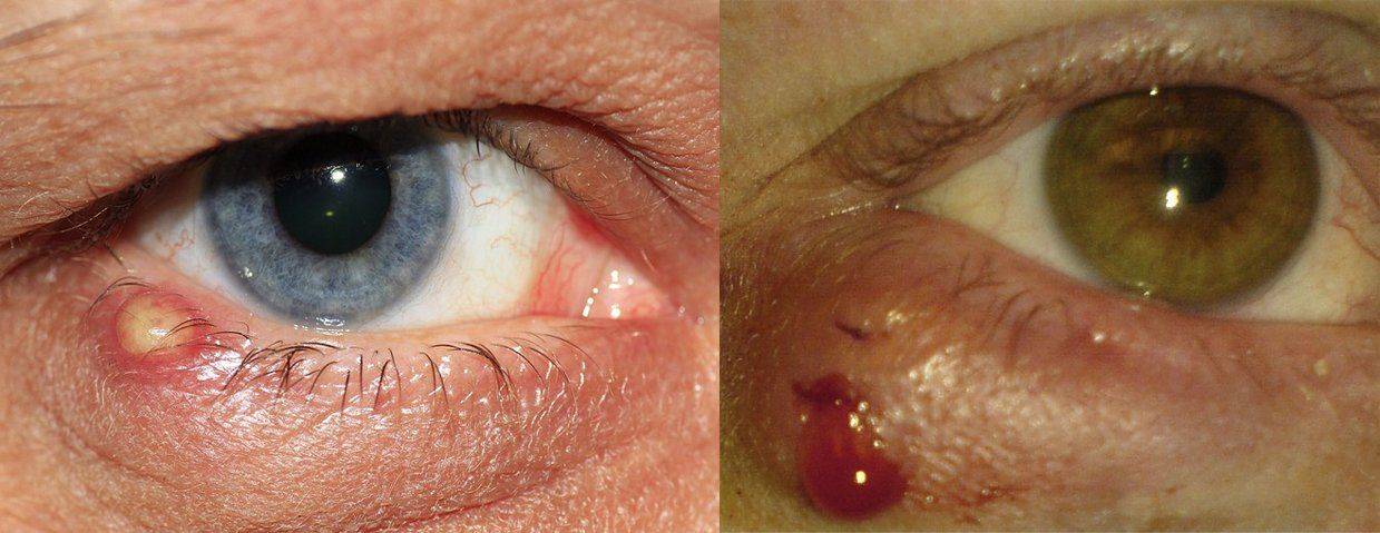 Два воспаления глаза Ячмень и халязион