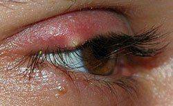 Как выглядит наружный ячмень Признаки наружного ячменя