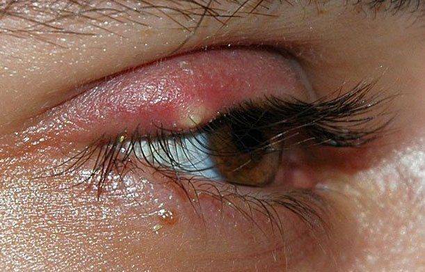Наружный ячмень Ячмень на верхнем веке