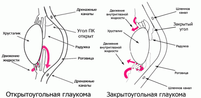 Внутриглазная жидкость при открыто- и закрытоугольной глаукоме Особенности открыто-и закрытоугольной глаукомы