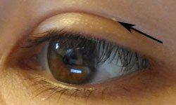 Жировик на глазу Как выглядит жировик